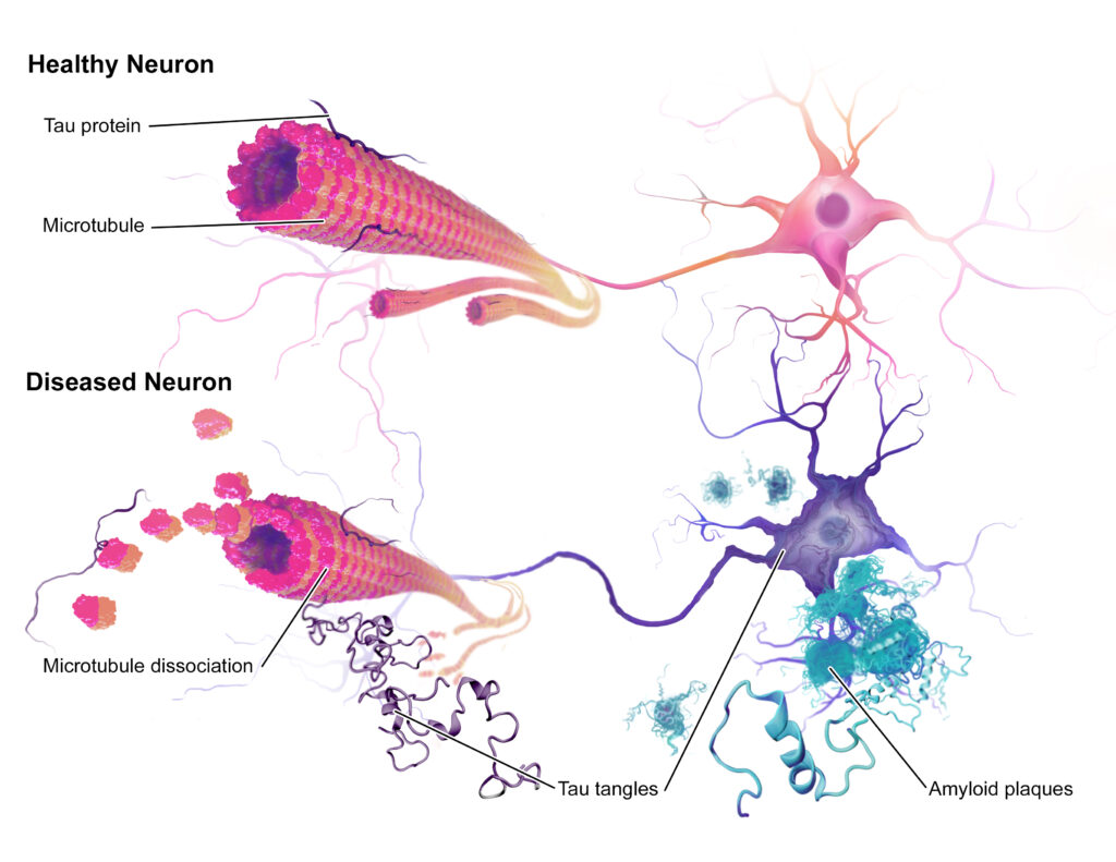 Alzheimer's disease